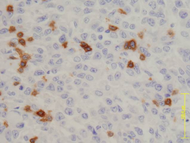 Fig.3: DLBCL. CD3 - <div style=